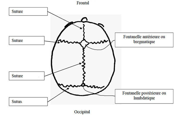 Traitement craniostenose Tunisie