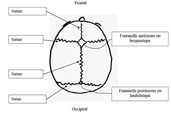 Traitement craniostenose Tunisie