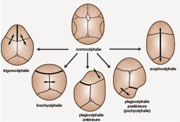 Traitement craniostenose Tunisie