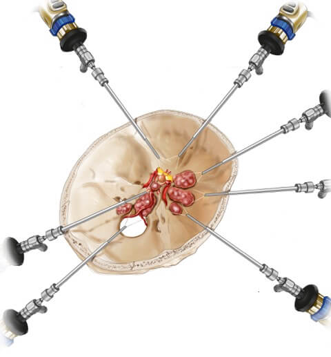 Endoscopie endonasale Tunisie