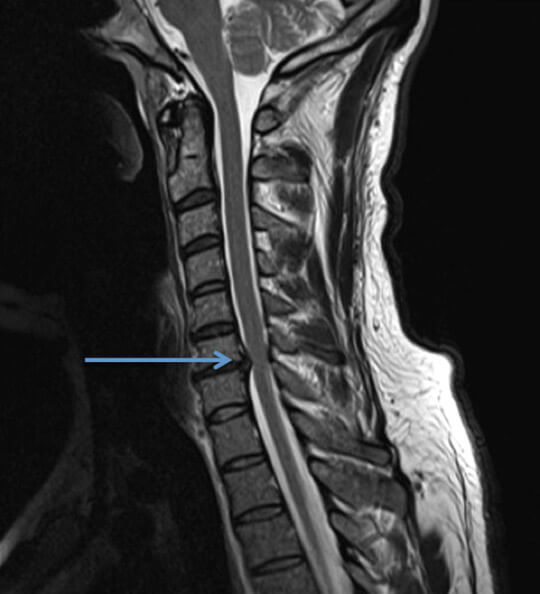 Hernie discale cervicale Tunisie | Dr Lassaad Bsili