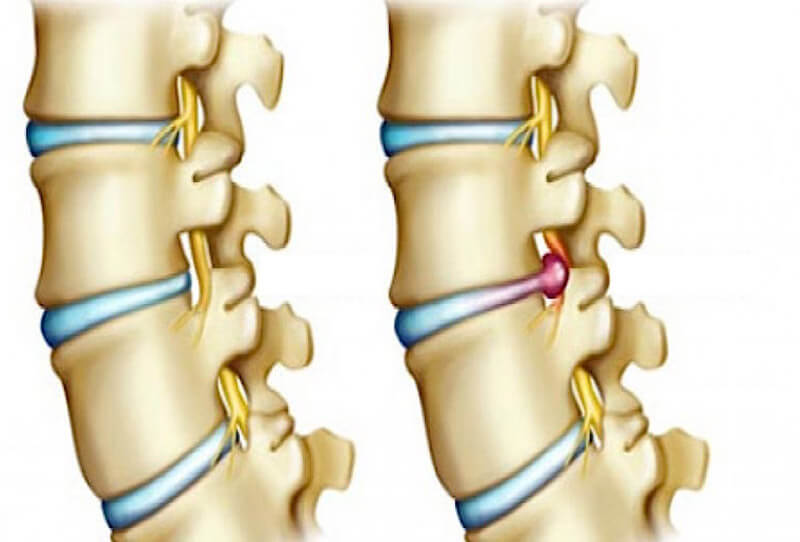 Hernie dicale lombaire Sousse Tunisie
