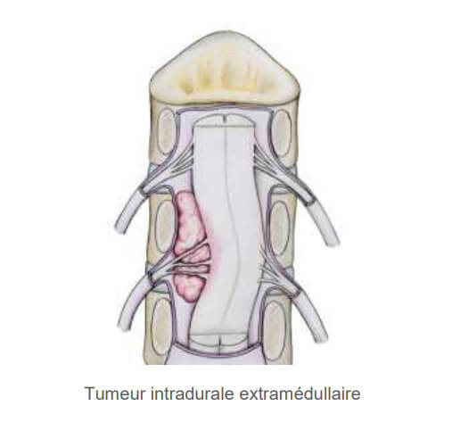 Tumeur de la moelle épinière Tunisie | Dr Lassaad Bsili