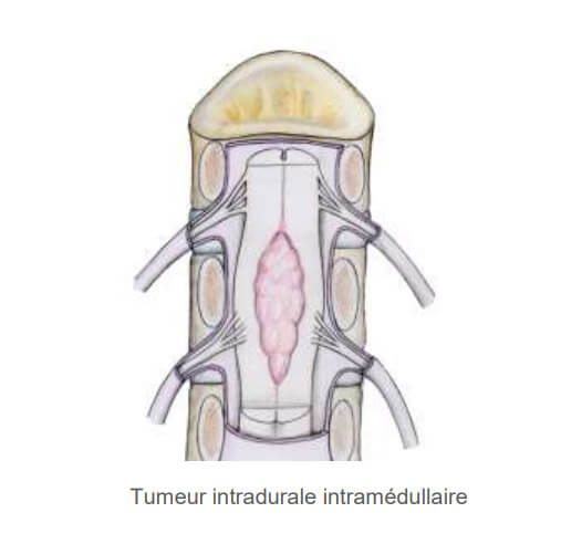 Tumeur de la moelle épinière Tunisie | Dr Lassaad Bsili