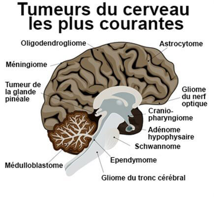 Tumeurs cérébrales Tunisie