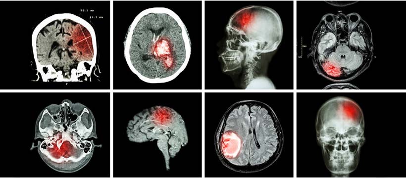 Un nouvel espoir pour les tumeurs cérébrales inopérables | Dr ...